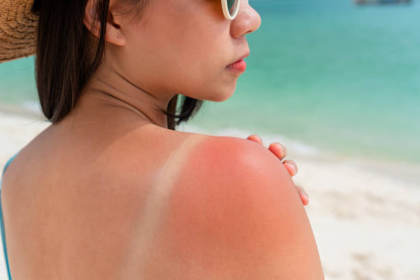 Sunburn Duration: What's Normal?